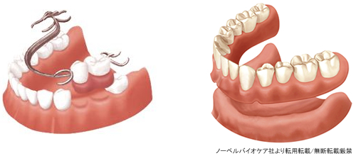 義歯治療