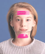 上顎の成長を促進する矯正治療（フェイシャルマスク）
