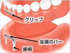 アタッチメント