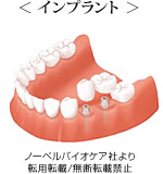 < インプラント >